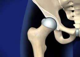 Femoral-Acetabular Impingement