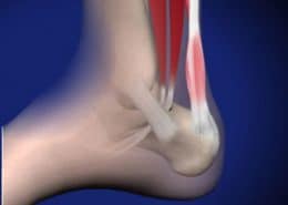 Achilles injury