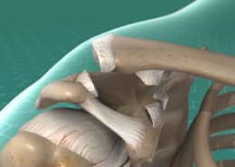 AC Joint Separation