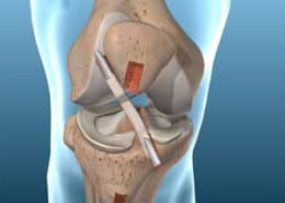 ACL reconstruction