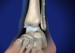 Ankle Fracture