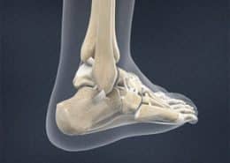 ankle sprain