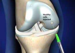 Healthy cells injected