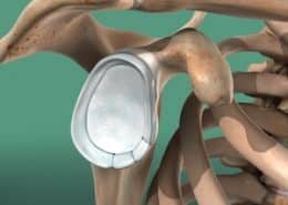 torn labrum