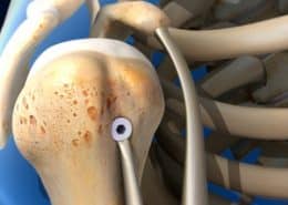 Biceps Tenodesis