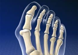 bunion