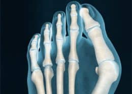 deformity of the toe joint