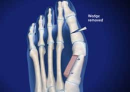 Bunion wedge removed