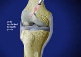 Cells implanted beneath patch