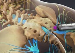 Caudal Epidural Steroid Injection