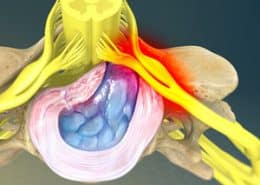 Herniated Disc