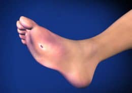 Charcot’s Neuroarthropathy