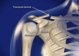 Fractured clavicle