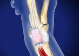 De Quervain’s Tenosynovitis