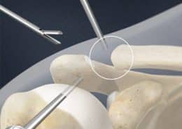 Distal Clavicle Excision