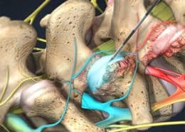 Facet Joint Injections