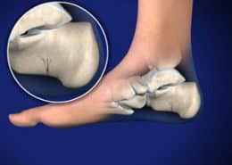 fractured heel bone