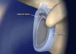 Labrum tears