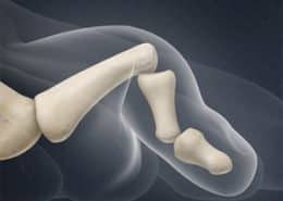 Hammer Toe