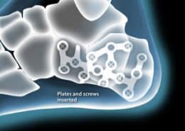 Heel fracture