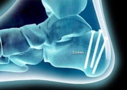 Screws in heel Tongue-Type Fracture