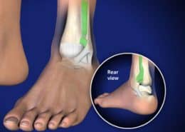 High Ankle Sprain