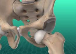 hip dislocation
