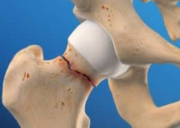 hip fracture