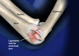 Ligaments stretched, torn