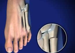 Jones Fracture