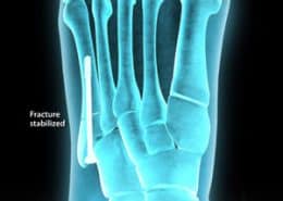 Fracture stabilized