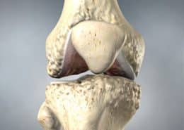knee arthritis