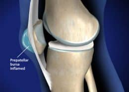 kneecap bursitis