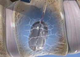 Kyphoplasty