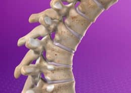 Kyphosis