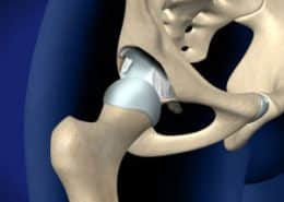 Labral Tears