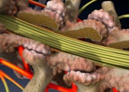 Laminectomy