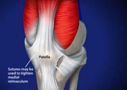 Patella sutures
