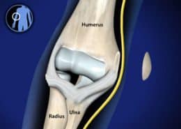 Medial Epicondylectomy