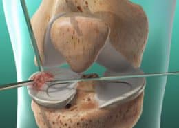 meniscus repair