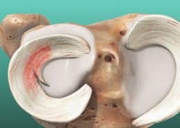 meniscus tears