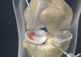 meniscus transplant