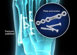 Fractures stabilized - plate and screws