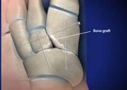 Bone graft