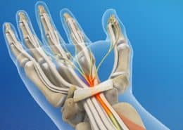 Open Carpal Tunnel Release