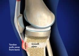 Tendon pulls away from bone