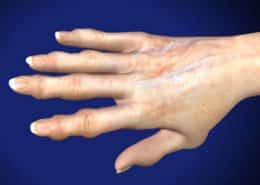 Osteoarthritis