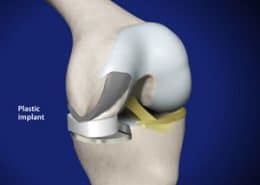 Plastic implant