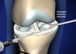 Damaged meniscus removed