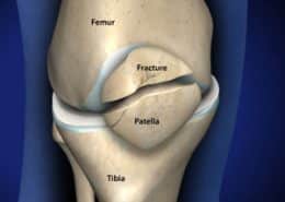 patella fracture